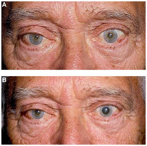 cocaine drop test|Horner syndrome and Cocaine .